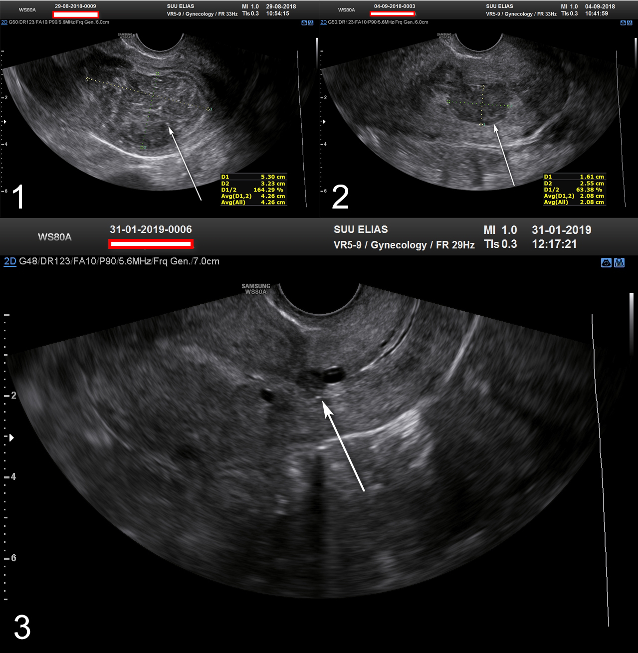 Single-step hysteroscopic myomectomy of a large type 2 uterine fibroid ...